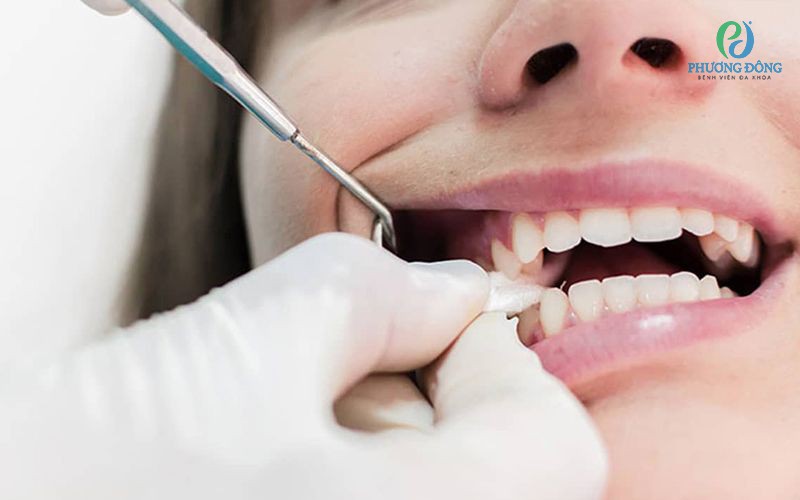 Chảy máu sau khi nhổ răng khôn bao lâu thì hết? Cách khắc phục