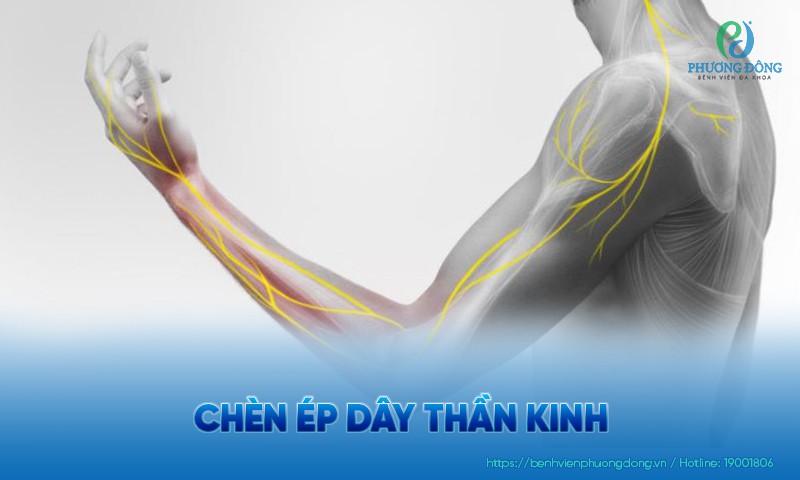 Chèn ép dây thần kinh: Triệu chứng, nguyên nhân và hướng điều trị