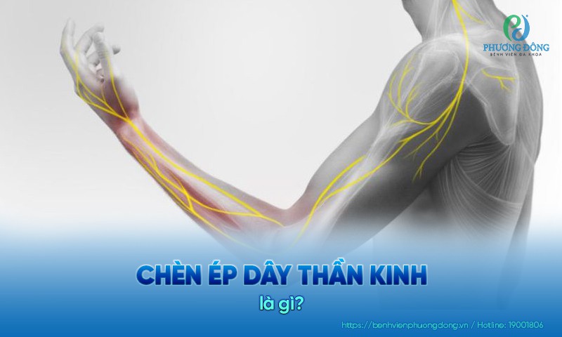 Chèn ép dây thần kinh là hiện tượng dây thần kinh bị ép hoặc nén lại