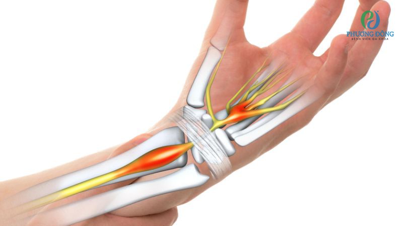 Các hội chứng kẹt dây thần kinh thường gặp