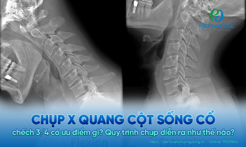 Chụp X quang cột sống cổ chếch ¾ có ưu điểm gì? Quy trình chụp diễn ra như thế nào?