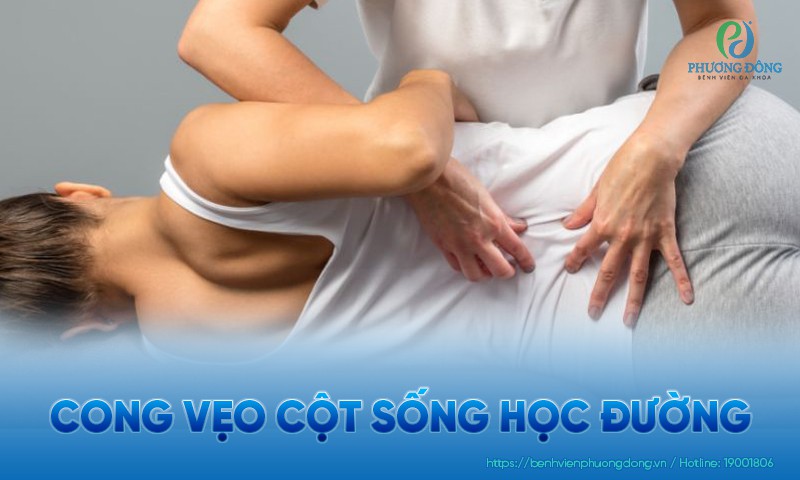 Cong vẹo cột sống học đường: Triệu chứng, phân biệt và điều trị