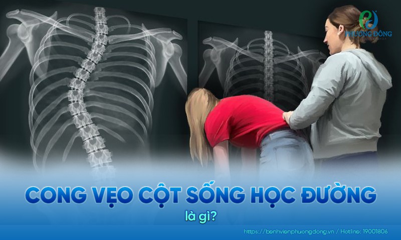 Cong vẹo cột sống học đường ảnh hưởng trực tiếp đến phần thắt lưng và ngực