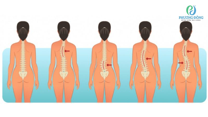 Phân biệt các loại gù vẹo cột sống học đường