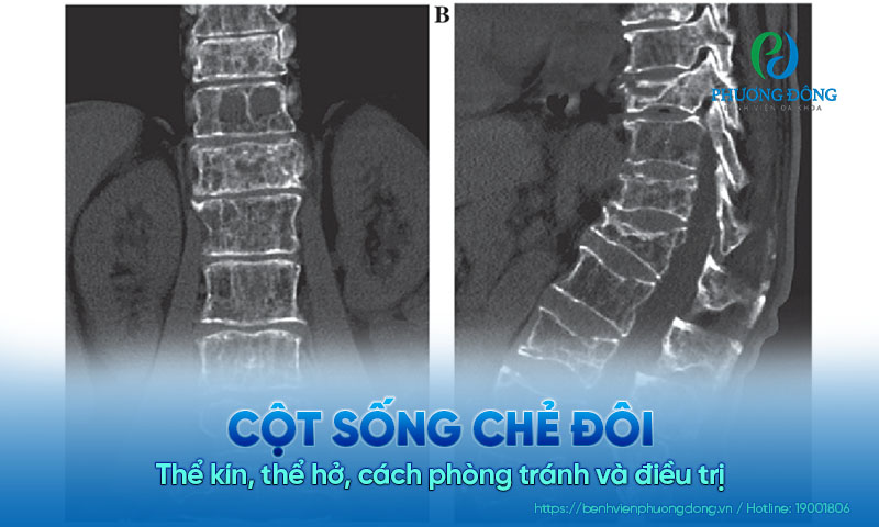 Cột sống chẻ đôi: Thể kín, thể hở, cách phòng tránh và điều trị