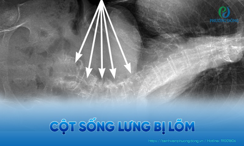 Cột sống lưng bị lõm: Đối tượng nguy cơ, biến chứng và điều trị