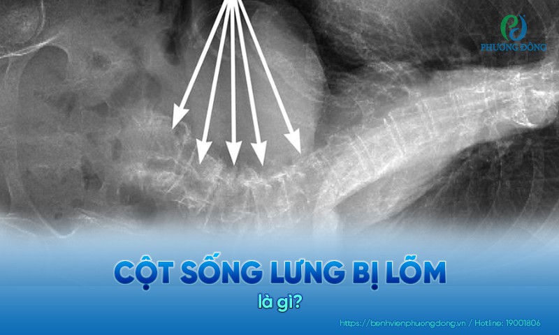 Cột sống lưng bị lõm là tình trạng lưng bị cong vào phía bên trong