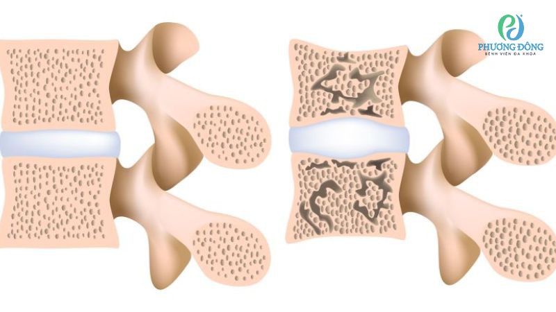 Biến chứng cần cẩn trọng đối với bệnh nhân cột sống lưng bị lõm