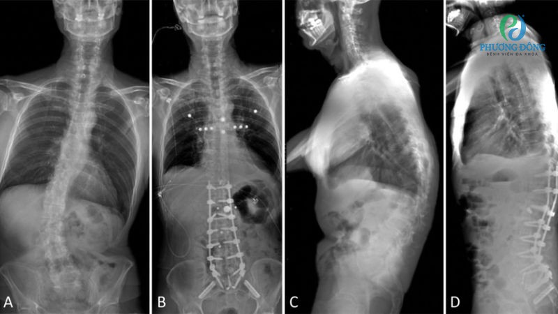 Phương pháp điều trị lõm cột sống lưng theo từng giai đoạn tiến triển