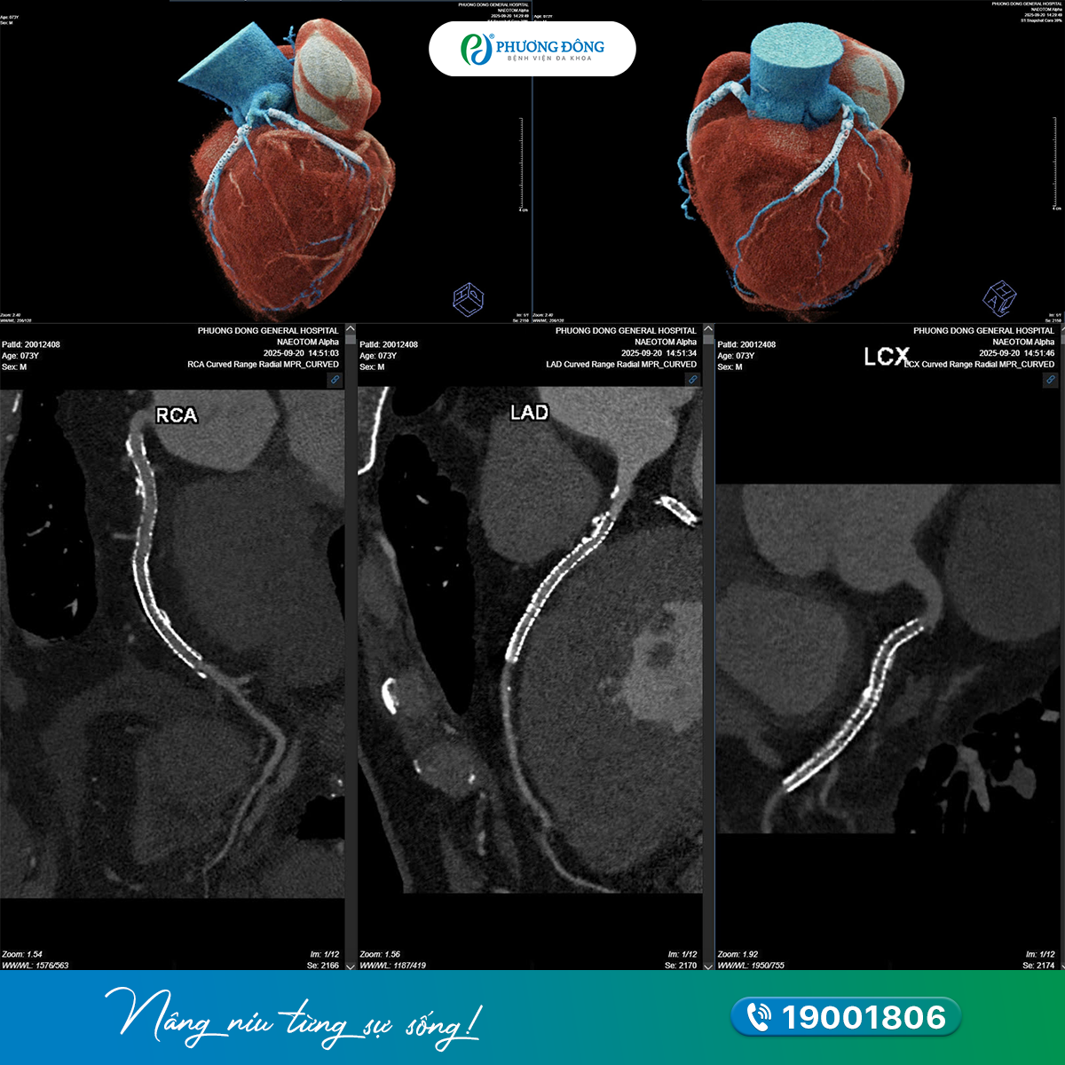 CT photon phát hiện chính xác phình động mạch và u gan ở bệnh nhân đã đặt stent