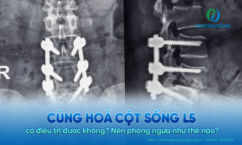 Cùng hoá cột sống L5 có điều trị được không? Nên phòng ngừa như thế nào?