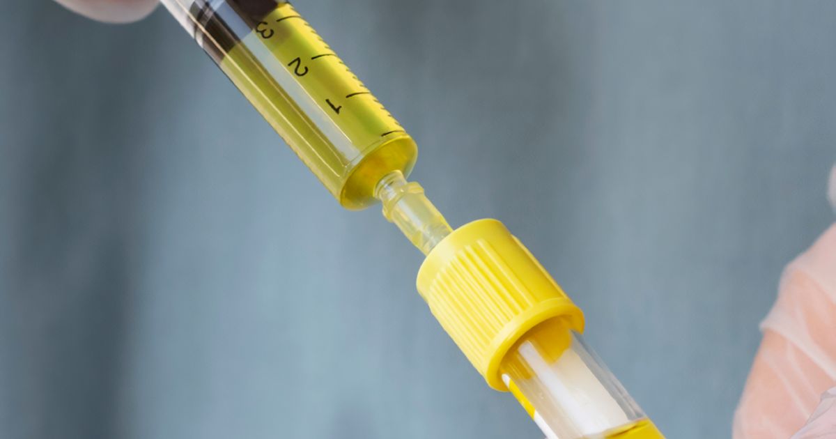 Huyết tương giàu tiểu cầu có thể được tiêm để giảm đau cho người bệnh