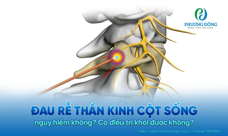 Đau rễ thần kinh cột sống nguy hiểm không? Có điều trị khỏi được không?
