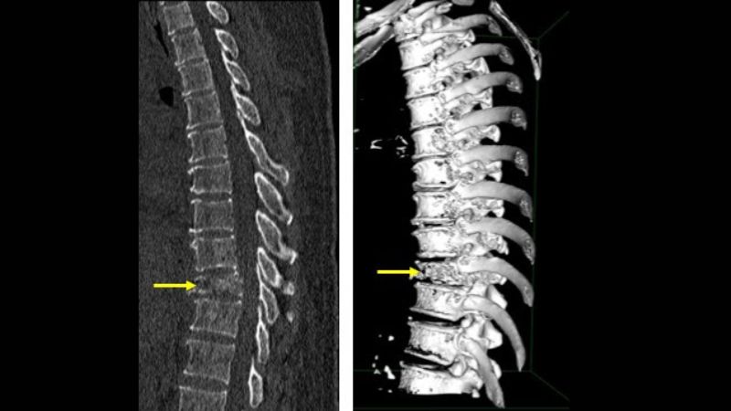 Lao cột sống có thể gây ra các cơn đau lưng dai dẳng