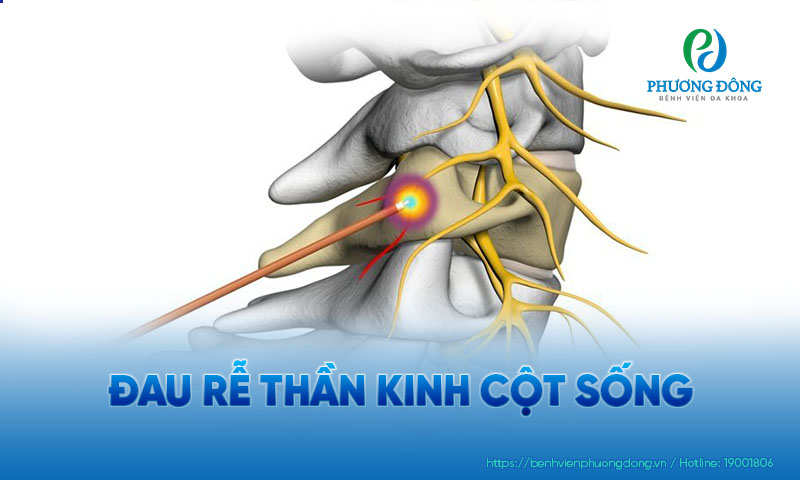 Các cơn đau rễ thần kinh ở cột sống có thể khiến người bệnh gặp nhiều khó khăn trong cuộc sống