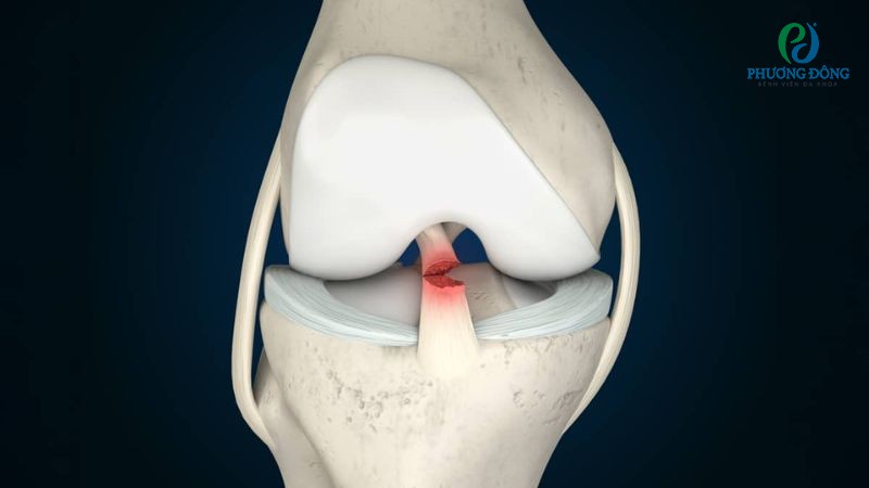 Dây chằng chéo trước có chức năng điều khiển các chuyển động xoay và di chuyển
