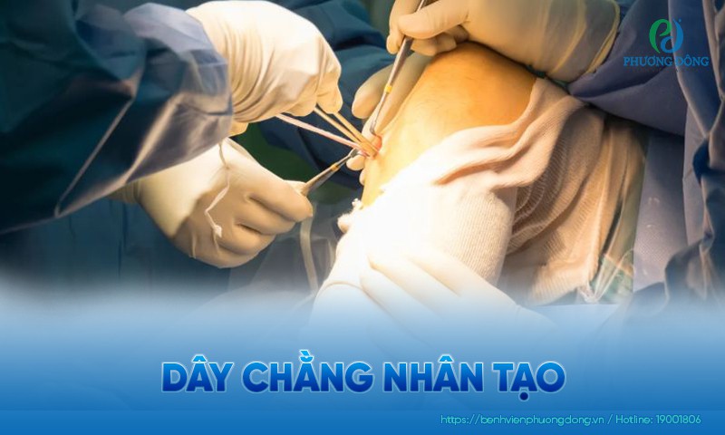 Dây chằng nhân tạo: Phân loại, ưu điểm và cách chăm sóc Dây chằng nhân tạo: Phân loại, ưu điểm và cách chăm sóc