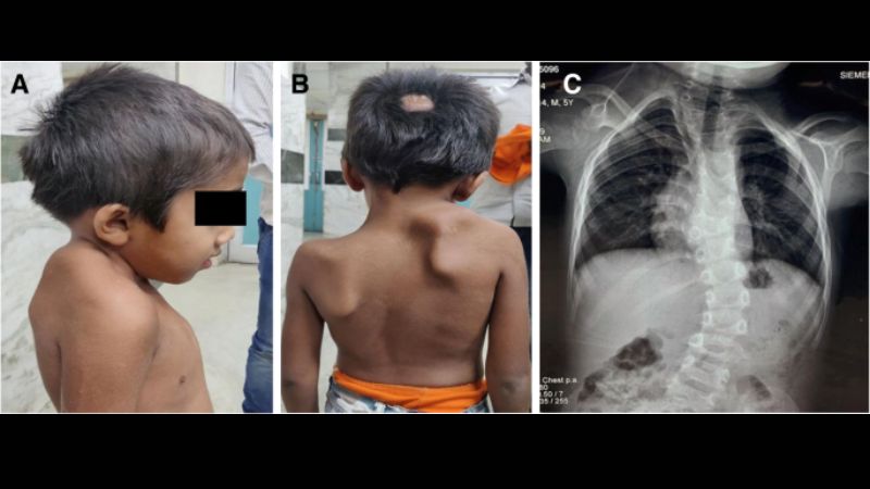 Em bé sinh ra với hội chứng Klippel- Feil