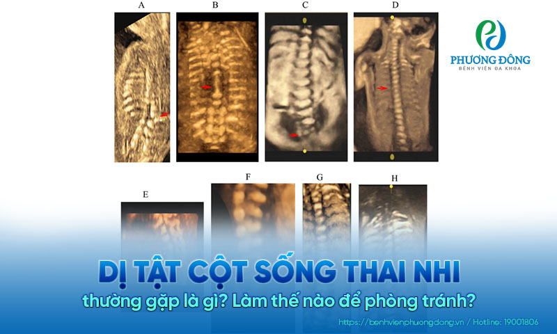Dị tật cột sống thai nhi thường gặp là gì? Làm thế nào để phòng tránh?