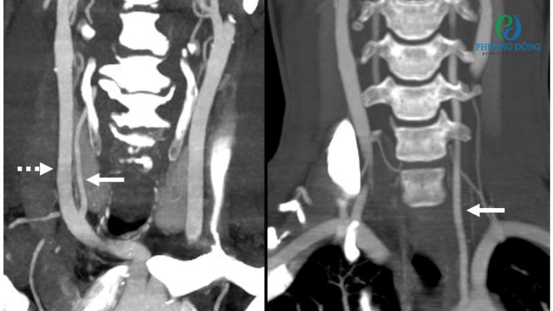 Chức năng và cấu trúc giải phẫu của hệ thống động mạch đốt sống