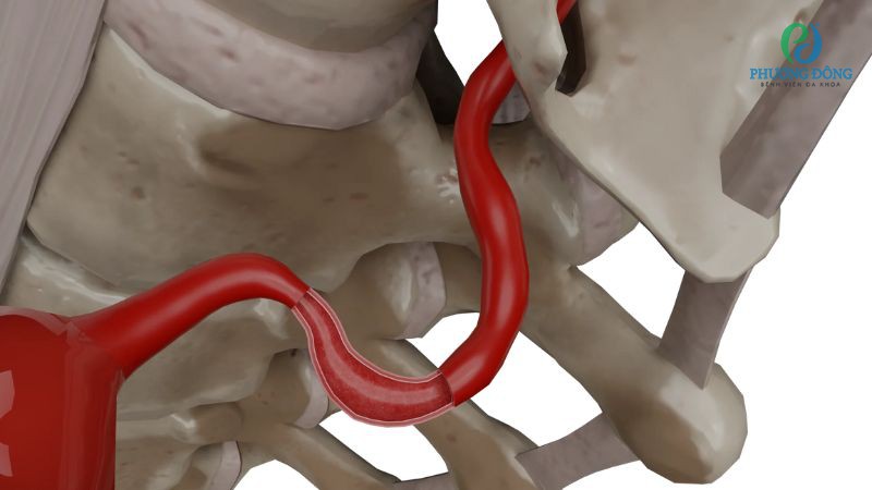 Phân loại dạng tổn thương động mạch theo nguyên nhân