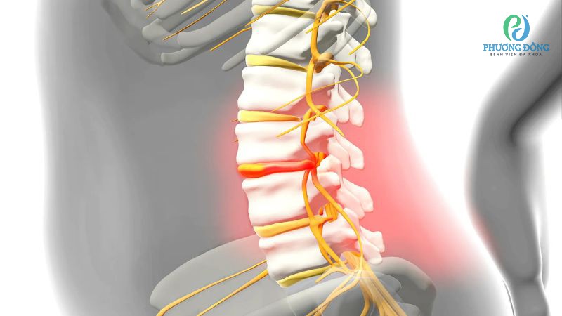 Thoát vị đĩa đệm cột sống cổ ngực làm khởi phát các cơn đau nhức nghiêm trọng
