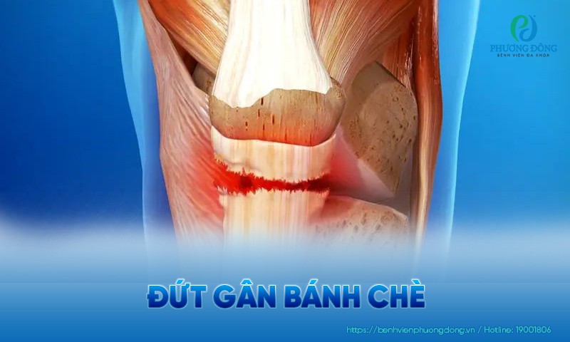 Đứt gân bánh chè: Triệu chứng, nguyên nhân và hướng điều trị
