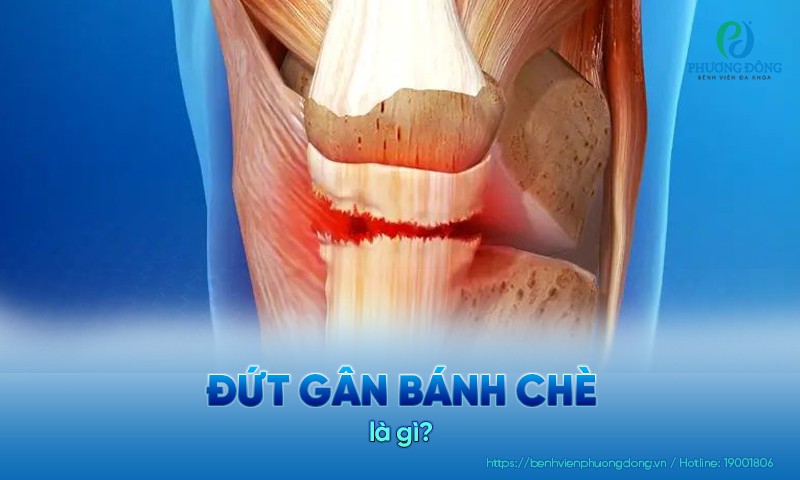 Đứt gân bánh chè là tình trạng gân nối từ xương bánh chè đến lồi củ chày bị rách