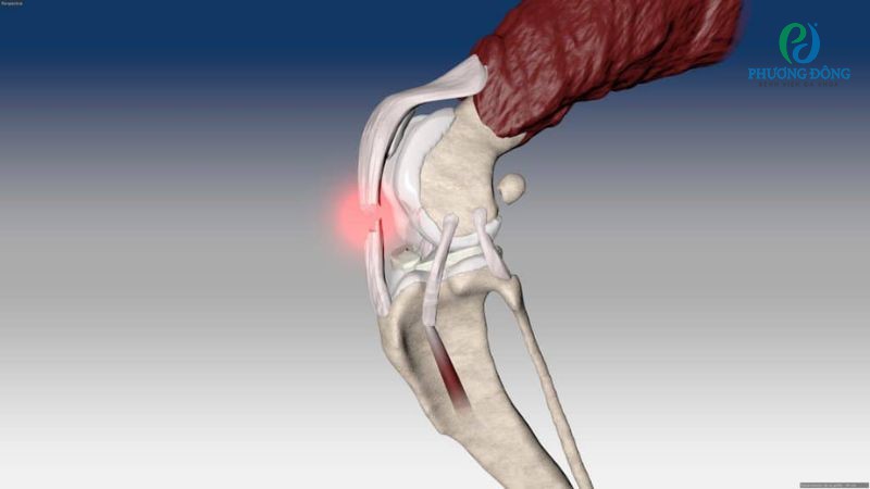 Phân độ tình trạng gân bánh chè bị đứt hoặc rách
