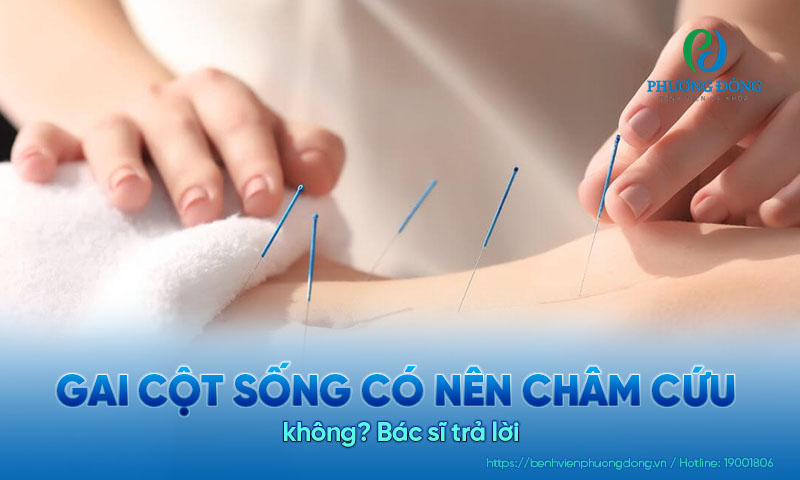 Bác sĩ trả lời: Gai cột sống có nên châm cứu không?