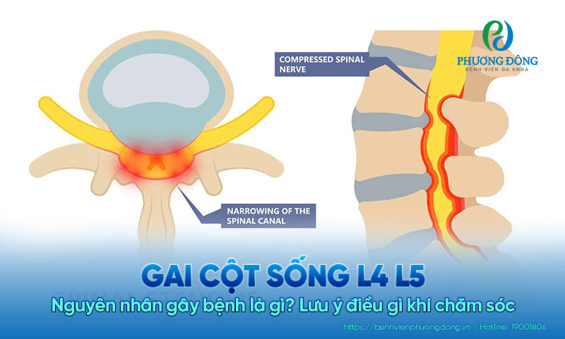 Nguyên nhân gây ra gai cột sống L4 L5 là gì? Lưu ý điều gì khi chăm sóc