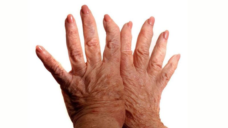 Một trong số các nguyên nhân dẫn đến gai xương là thoái hoá khớp