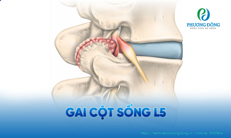 Các mấu xương nhỏ hình thành ở cột sống hay còn gọi là các gai