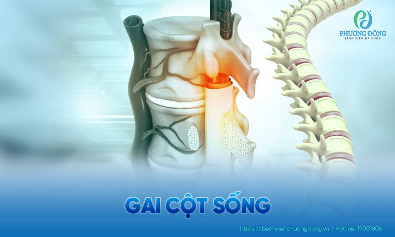 Gai cột sống: Nguyên nhân, triệu chứng và hướng điều trị