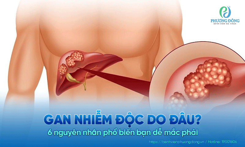 Gan nhiễm độc do đâu? 6 nguyên nhân phổ biến bạn dễ mắc phải