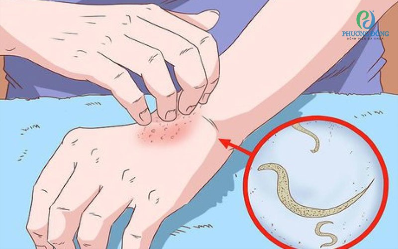 Sự hiện diện của giun sán làm cơ thể phản ứng bằng cách sản xuất các chất gây viêm, dẫn đến cảm giác ngứa ngáy.