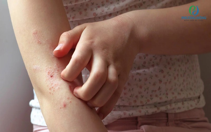 Triệu chứng ngứa ngáy khi bị nhiễm sán