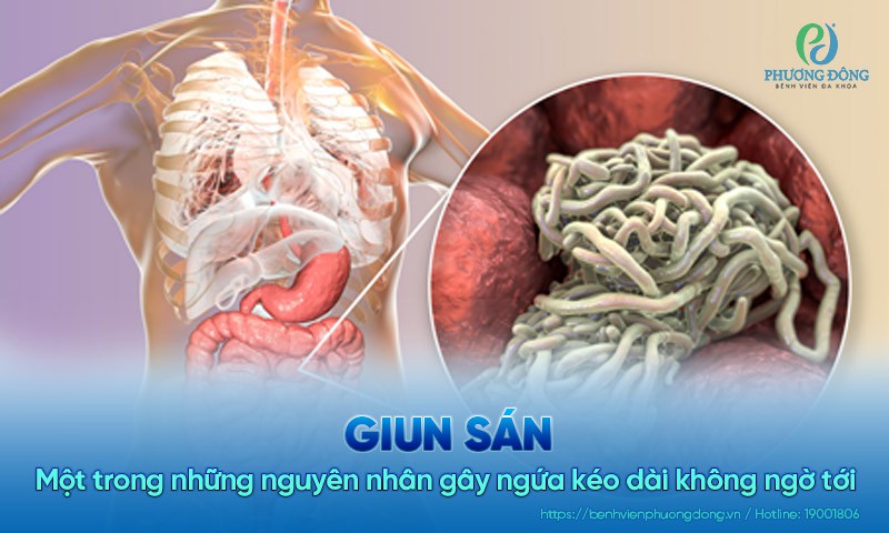 Giun sán – Một trong những nguyên nhân gây ngứa kéo dài không ngờ tới