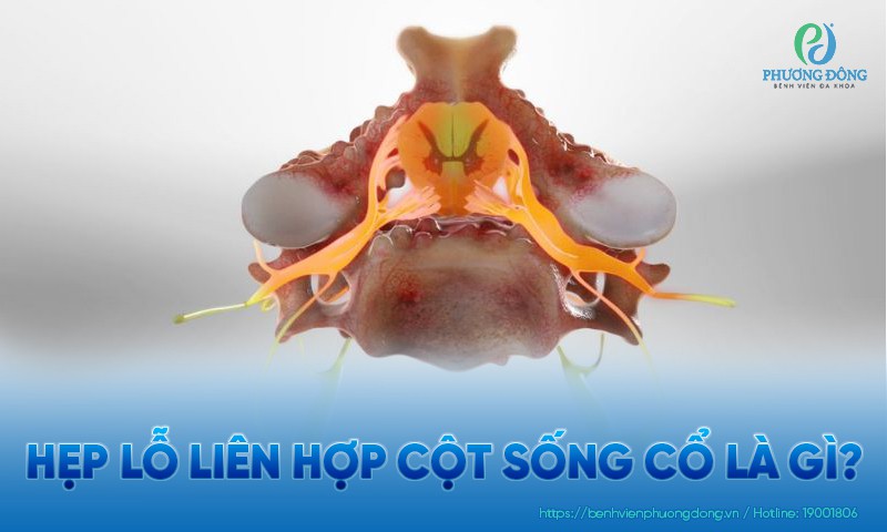 Hẹp lỗ liên hợp cột sống cổ là gì? Triệu chứng, nguyên nhân và điều trị Hẹp lỗ liên hợp cột sống cổ là gì? Triệu chứng, nguyên nhân và điều trị