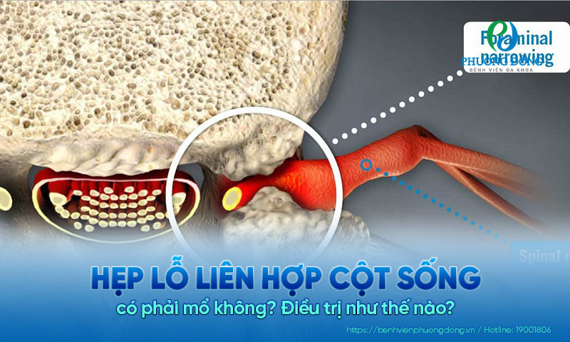 Hẹp lỗ liên hợp cột sống có phải mổ không? Điều trị như thế nào?