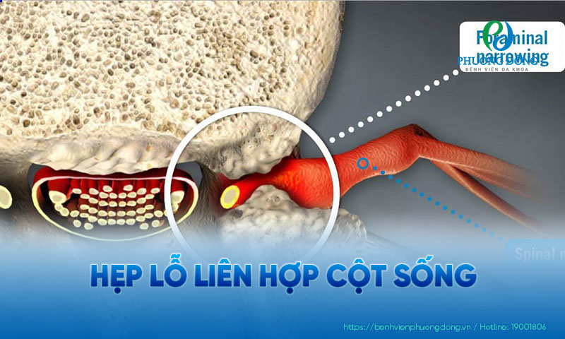 Minh hoạ hình ảnh lỗ liên hợp cột sống bị hẹp