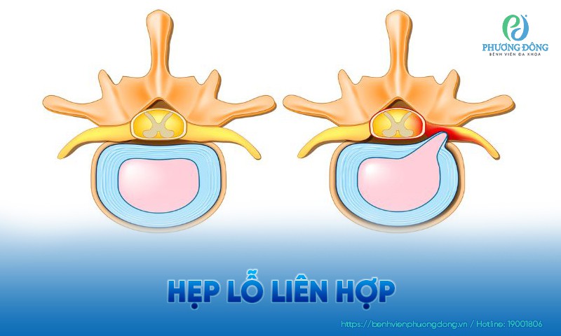Hẹp lỗ liên hợp: Triệu chứng, chẩn đoán và hướng điều trị