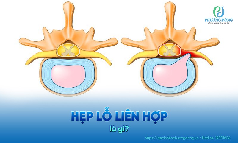 Các dạng hẹp lỗ liên hợp đốt sống thường gặp
