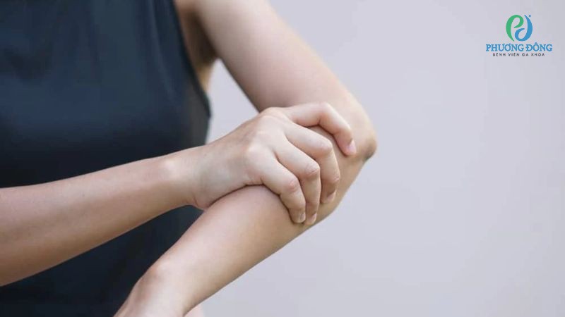 Tê bì cánh tay thường xảy ra khi dây thần kinh cột sống bị chèn ép nghiêm trọng