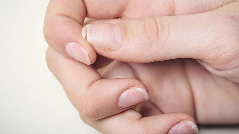 Chế độ dinh dưỡng thiếu canxi cũng có thể tăng nguy cơ mắc bệnh lý này