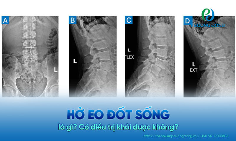 Hở eo đốt sống là gì? Có điều trị khỏi được không?