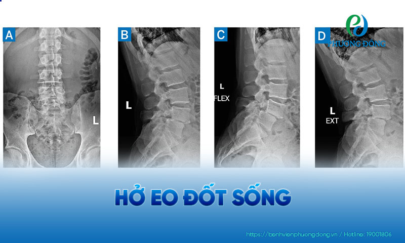 Đốt sống có thể bị hở eo