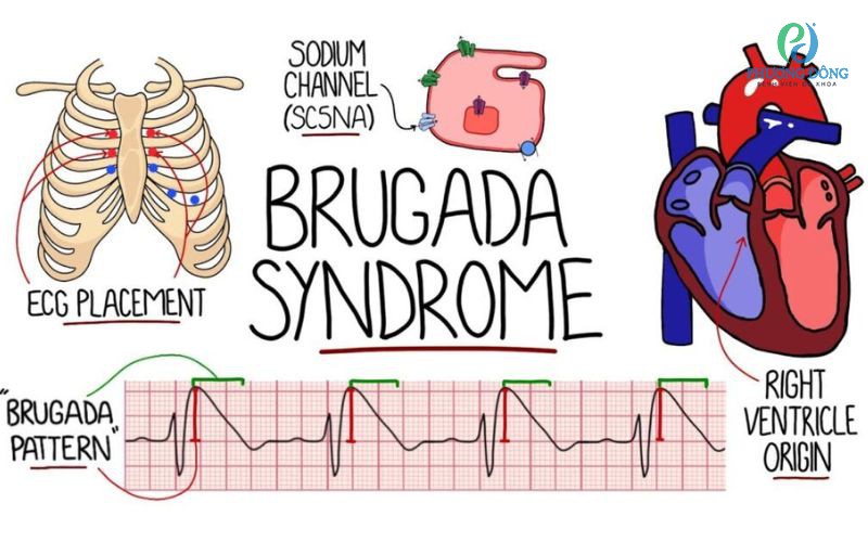 Hội chứng Brugada và những điều cần biết 