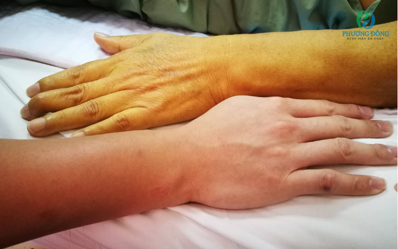 Tình trạng vàng da ở người bệnh