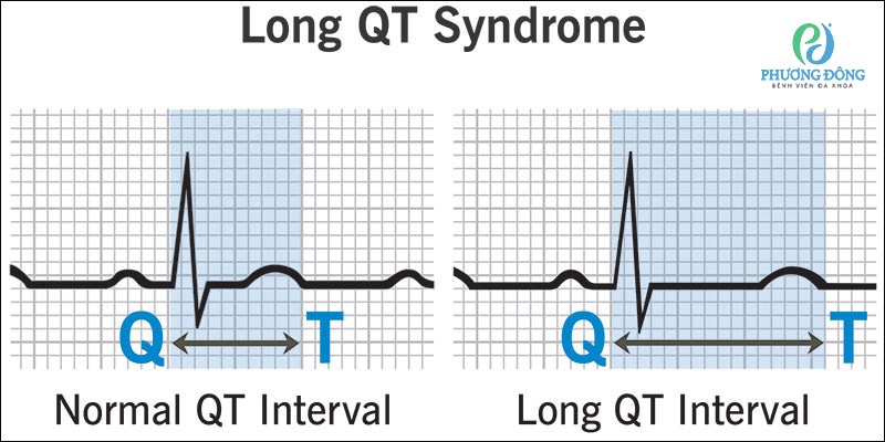 Hội chứng QT dài là một rối loạn di truyền ảnh hưởng đến hệ thống điện của tim dẫn đến kéo dài khoảng QT trong điện tâm đồ (ECG)